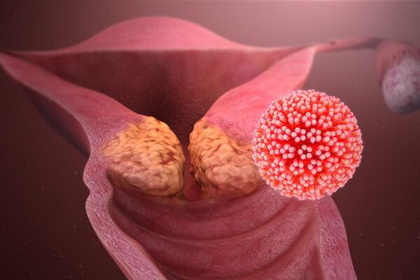 Genital Siğiller ve Hpv Virüsü Nedir? - Genital Sağlık